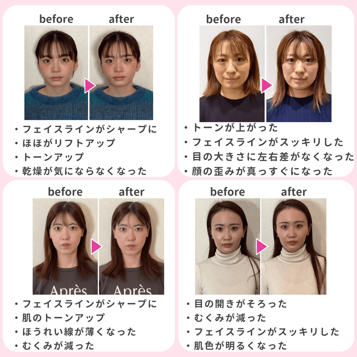 福岡市中央区警固にある鍼灸整体HARISUL警固院の美容鍼灸のBA画像
