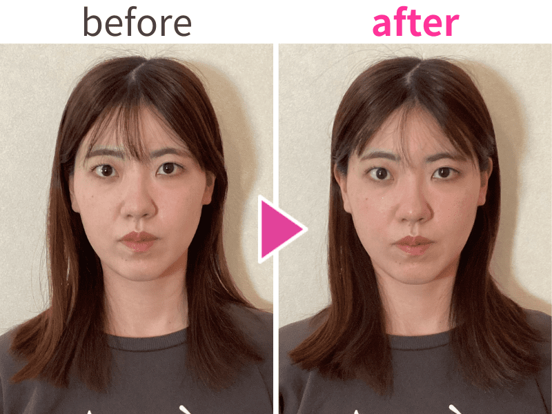 フェイスラインの変化