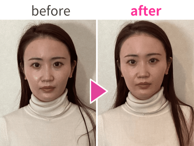 ほうれい線の変化