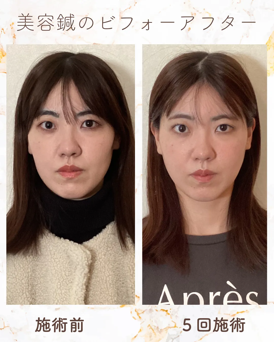 川崎様の事例 施術前と5回施術後の比較
